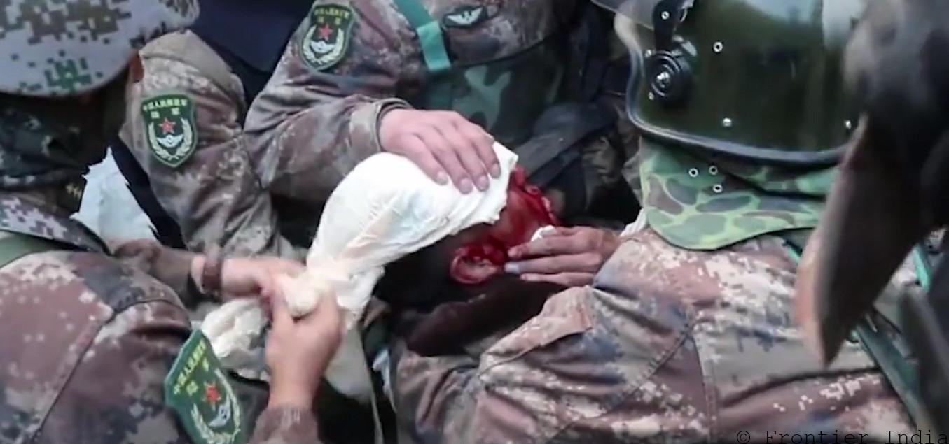 Chinese PLA Soldier injured at Galwan Valley Clash with the-Indian Army